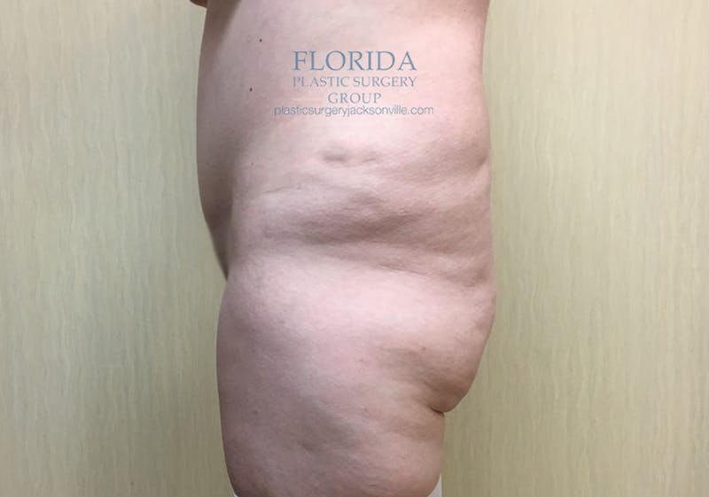 Lower Body Lift Before & After Gallery - Patient 154948930 - Image 3