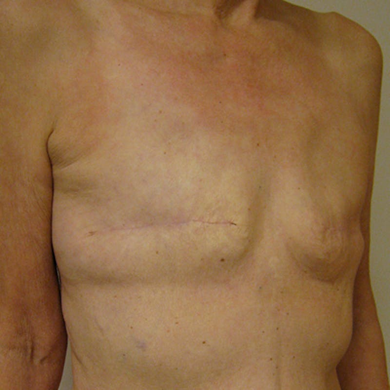 Latissimus Flap Reconstruction Before & After Gallery - Patient 154948933 - Image 3