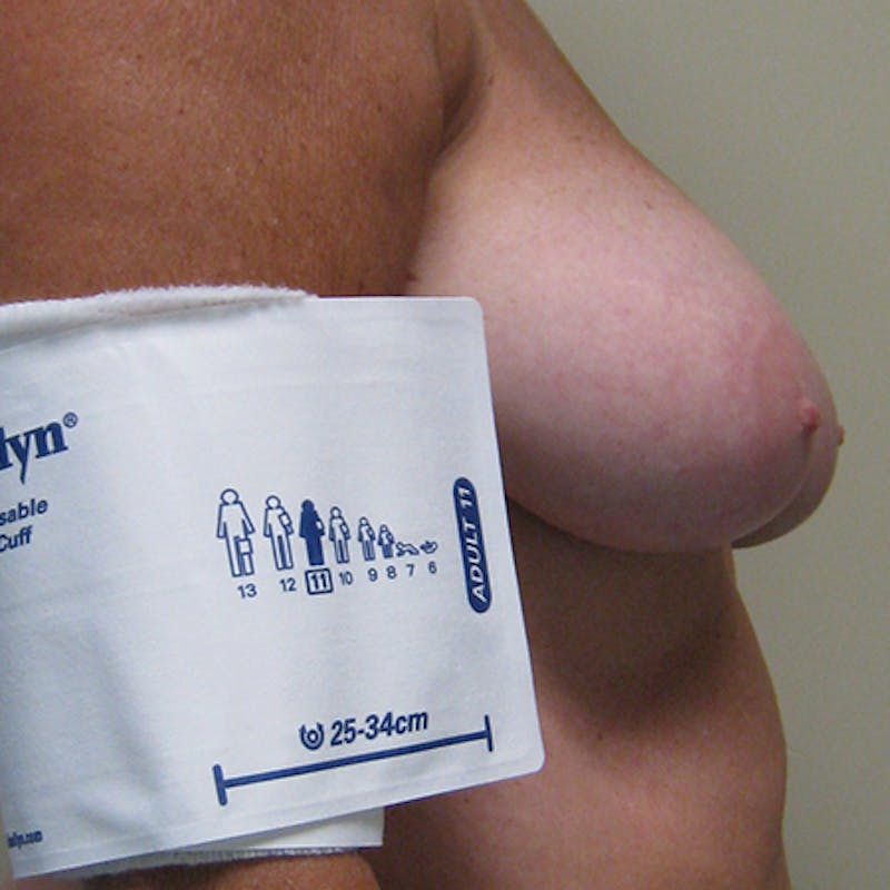 DIEP Flap Reconstruction Before & After Gallery - Patient 154948931 - Image 5