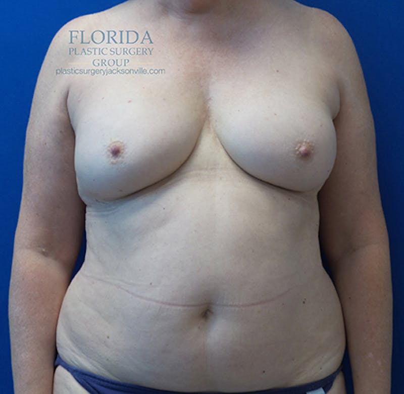 Nipple Sparing Breast Reconstruction Before & After Gallery - Patient 154948955 - Image 1