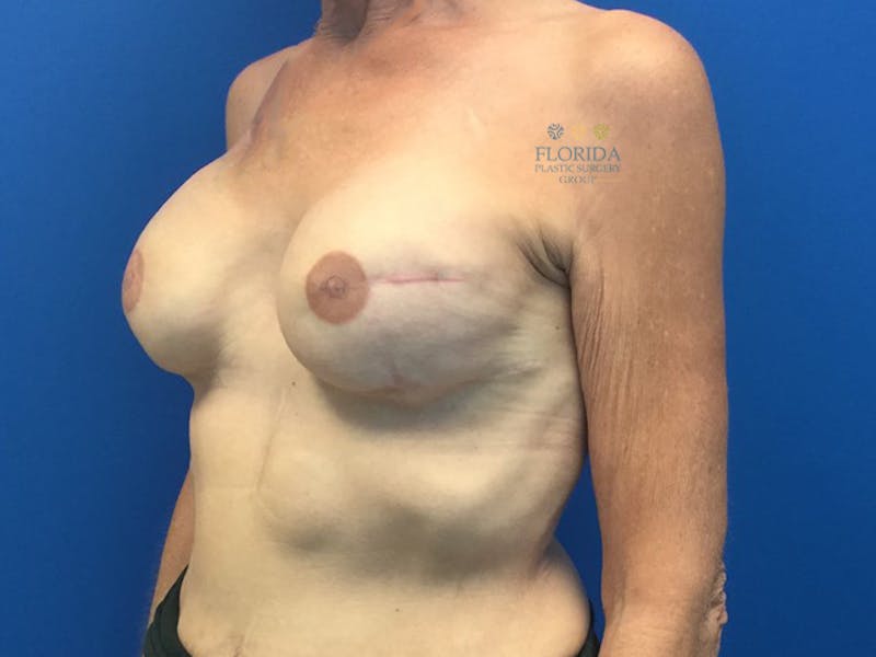 Breast Reconstruction Revision Before & After Gallery - Patient 154948934 - Image 8