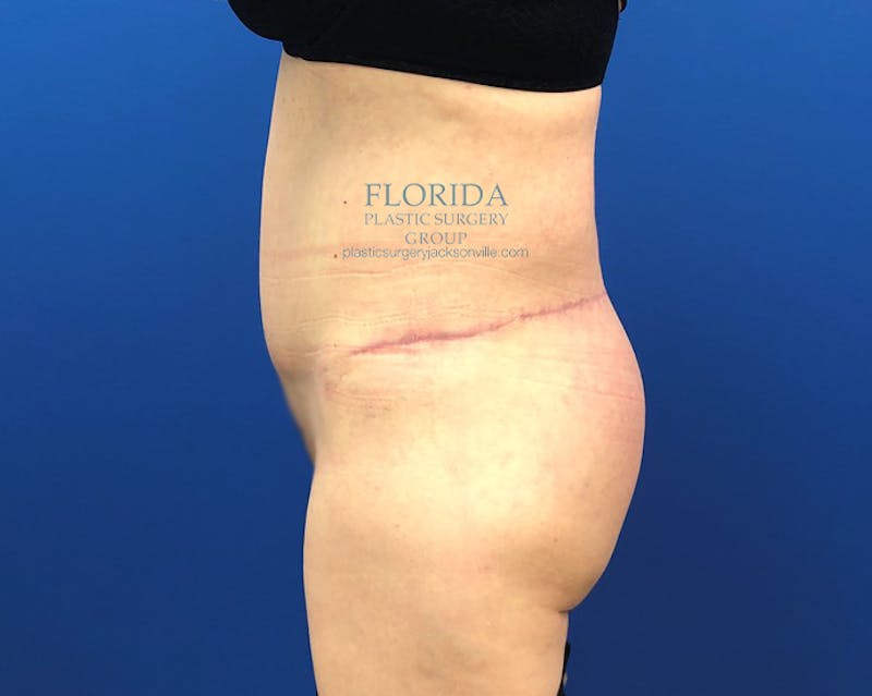 Lower Body Lift Before & After Gallery - Patient 154948930 - Image 4