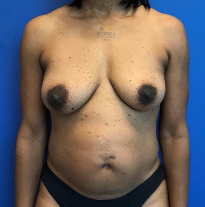 Augmentation Mastopexy Before & After Gallery - Patient 154948939 - Image 1