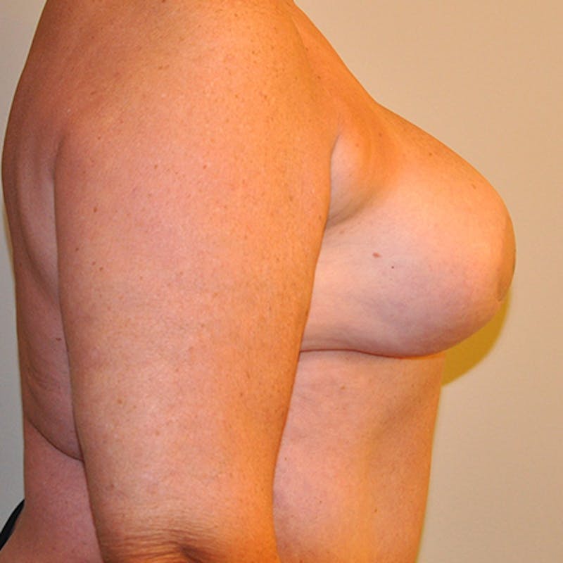 DIEP Flap Reconstruction Before & After Gallery - Patient 154948931 - Image 6