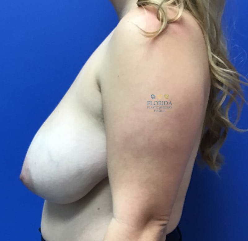 Breast Reduction Before & After Gallery - Patient 154948942 - Image 3