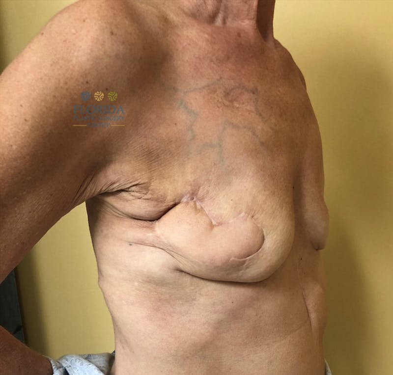 Breast Reconstruction Revision Before & After Gallery - Patient 154948934 - Image 9