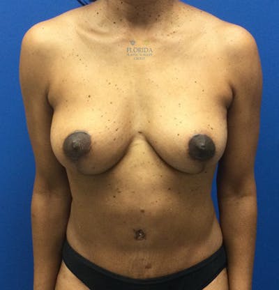 Augmentation Mastopexy Before & After Gallery - Patient 154948939 - Image 2