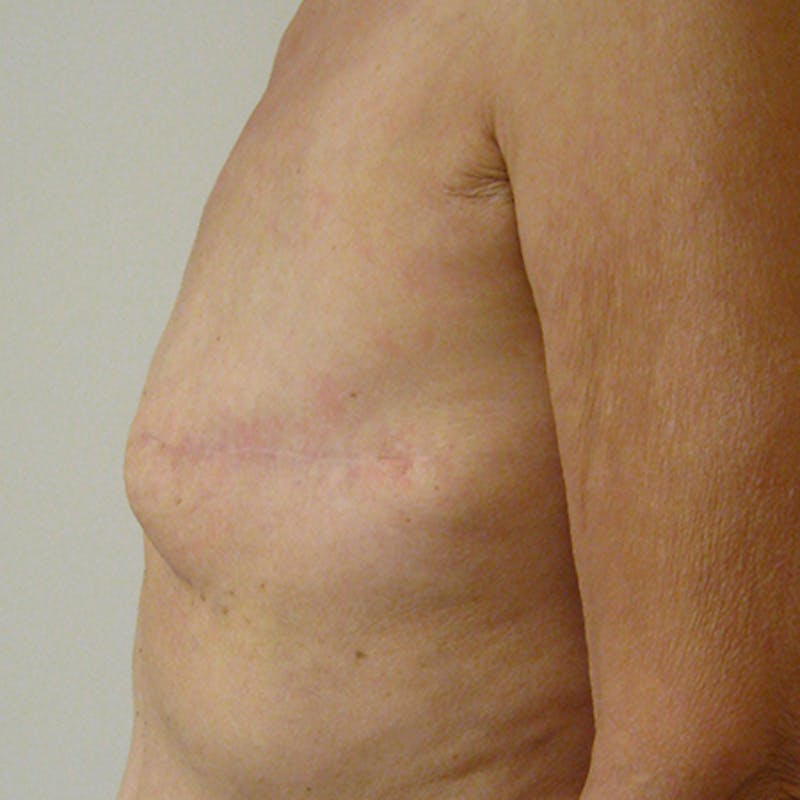Latissimus Flap Reconstruction Before & After Gallery - Patient 154948933 - Image 5