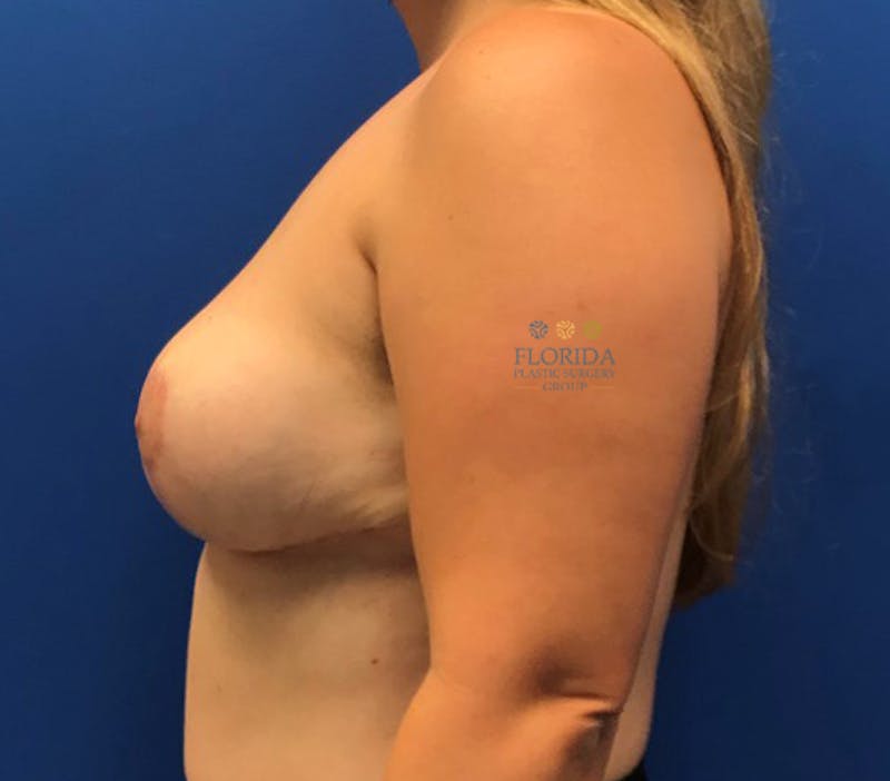 Breast Reduction Before & After Gallery - Patient 154948942 - Image 4