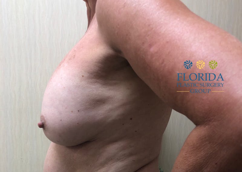 Breast Implant Removal Before & After Gallery - Patient 154948938 - Image 3
