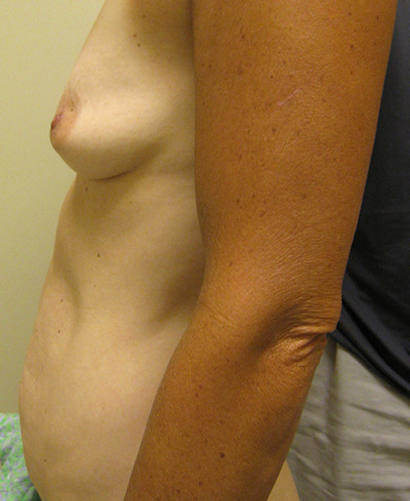 Mommy Makeover Before & After Gallery - Patient 154948936 - Image 5