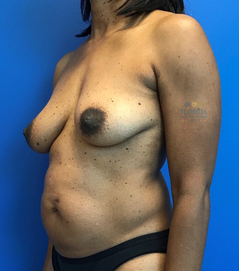 Augmentation Mastopexy Before & After Gallery - Patient 154948939 - Image 3