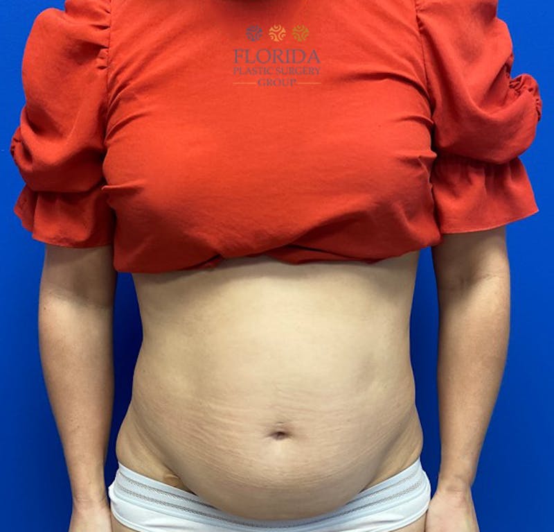 Abdominoplasty Before & After Gallery - Patient 154948954 - Image 1