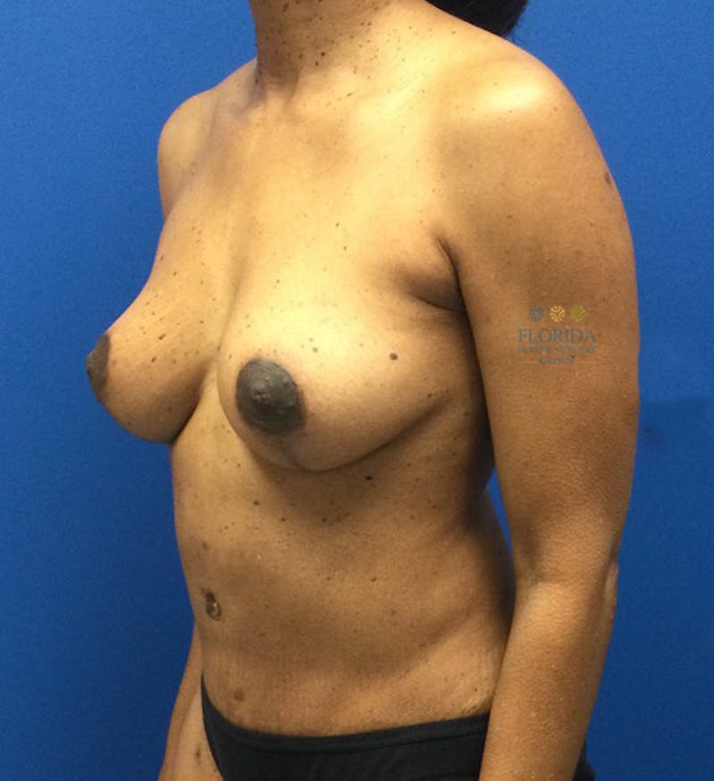 Augmentation Mastopexy Before & After Gallery - Patient 154948939 - Image 4