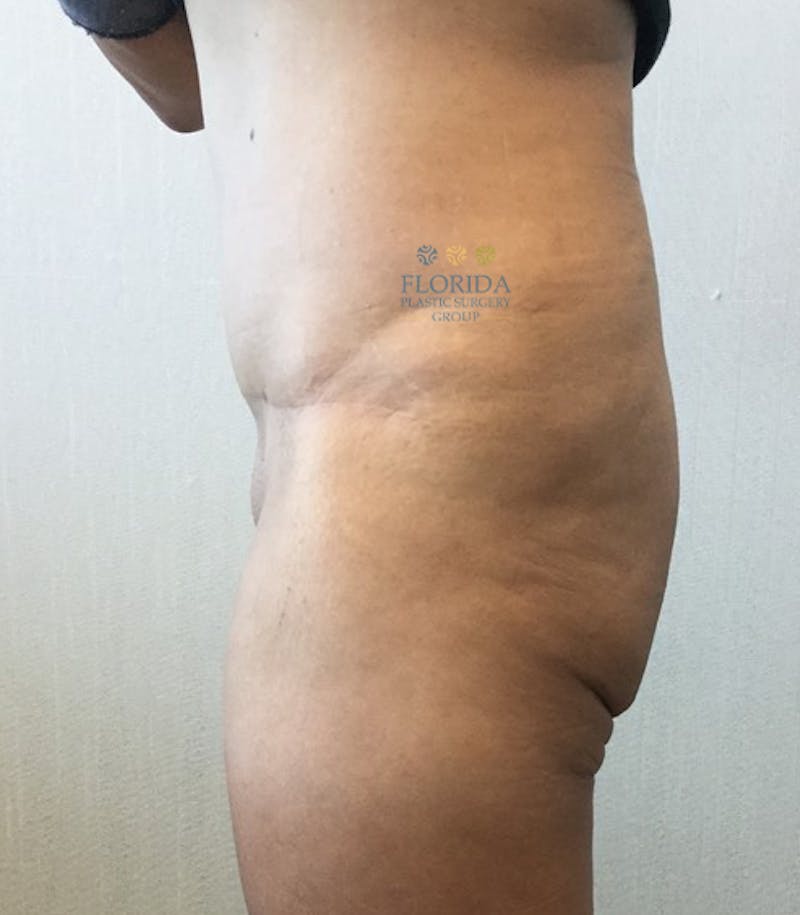 Lower Body Lift Before & After Gallery - Patient 154948944 - Image 3