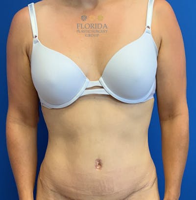 Abdominoplasty Before & After Gallery - Patient 154948954 - Image 2