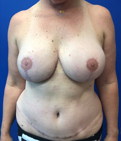 DIEP Flap Reconstruction Before & After Gallery - Patient 154948961 - Image 2