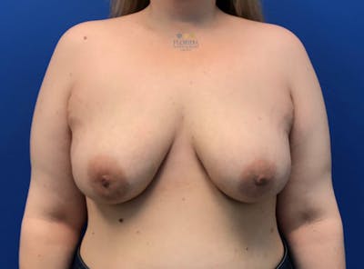 Breast Implant Removal Before & After Gallery - Patient 154948951 - Image 2