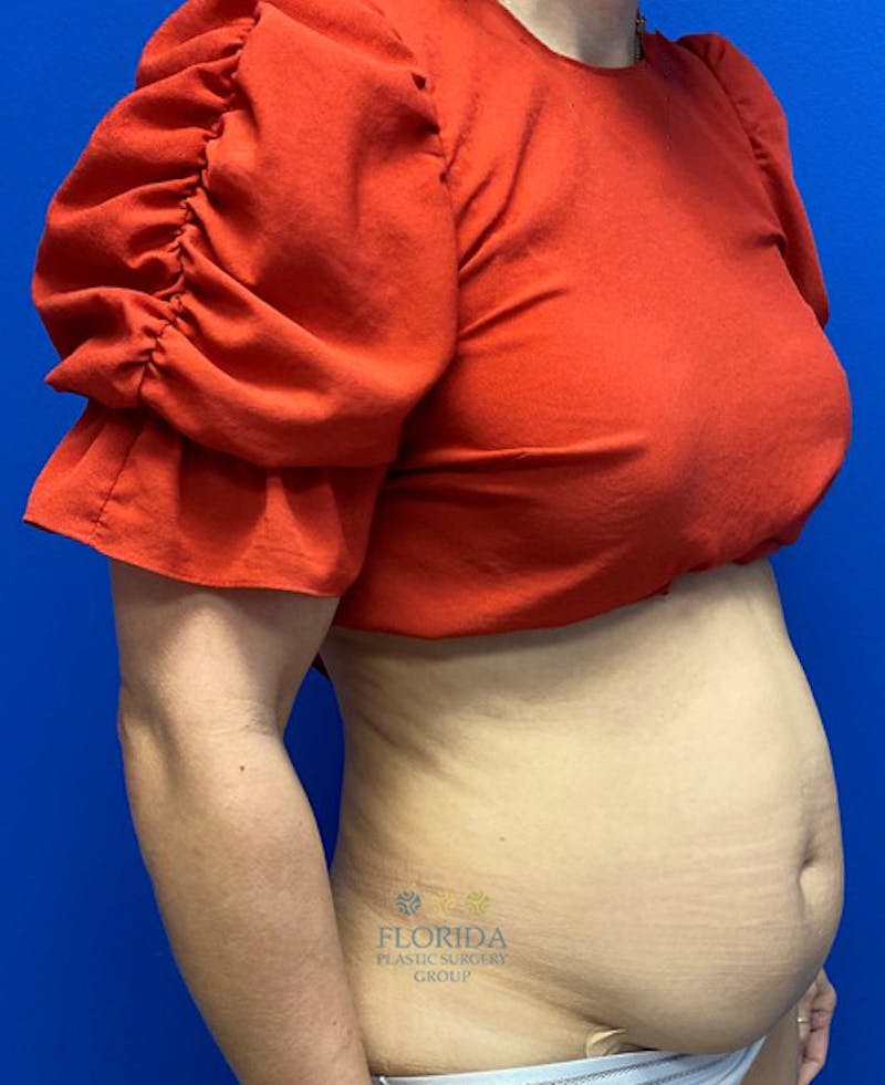 Abdominoplasty Before & After Gallery - Patient 154948954 - Image 3