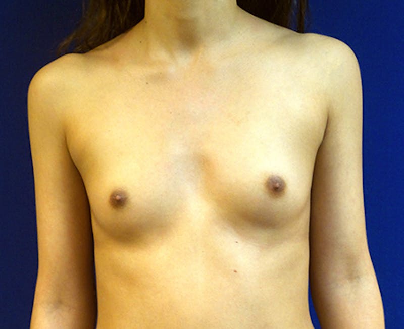 Silicone Breast Augmentation Before & After Gallery - Patient 154948956 - Image 1