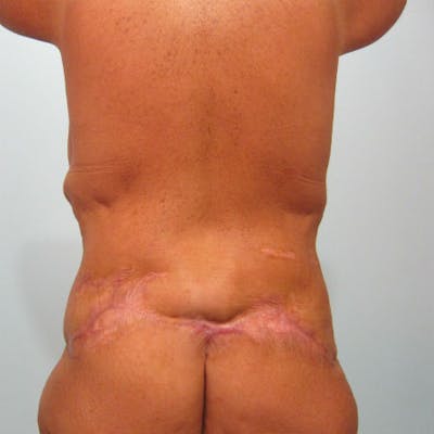 Lower Body Lift Before & After Gallery - Patient 154948949 - Image 1