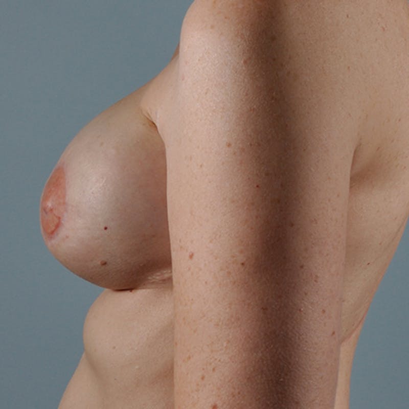 Latissimus Flap Reconstruction Before & After Gallery - Patient 154948948 - Image 4