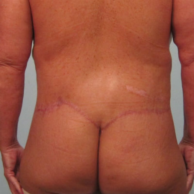 Lower Body Lift Before & After Gallery - Patient 154948949 - Image 2