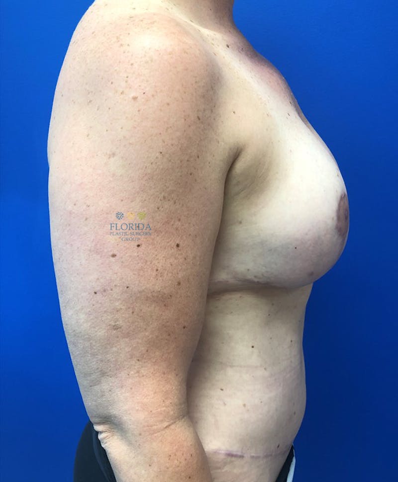 DIEP Flap Reconstruction Before & After Gallery - Patient 154948961 - Image 4