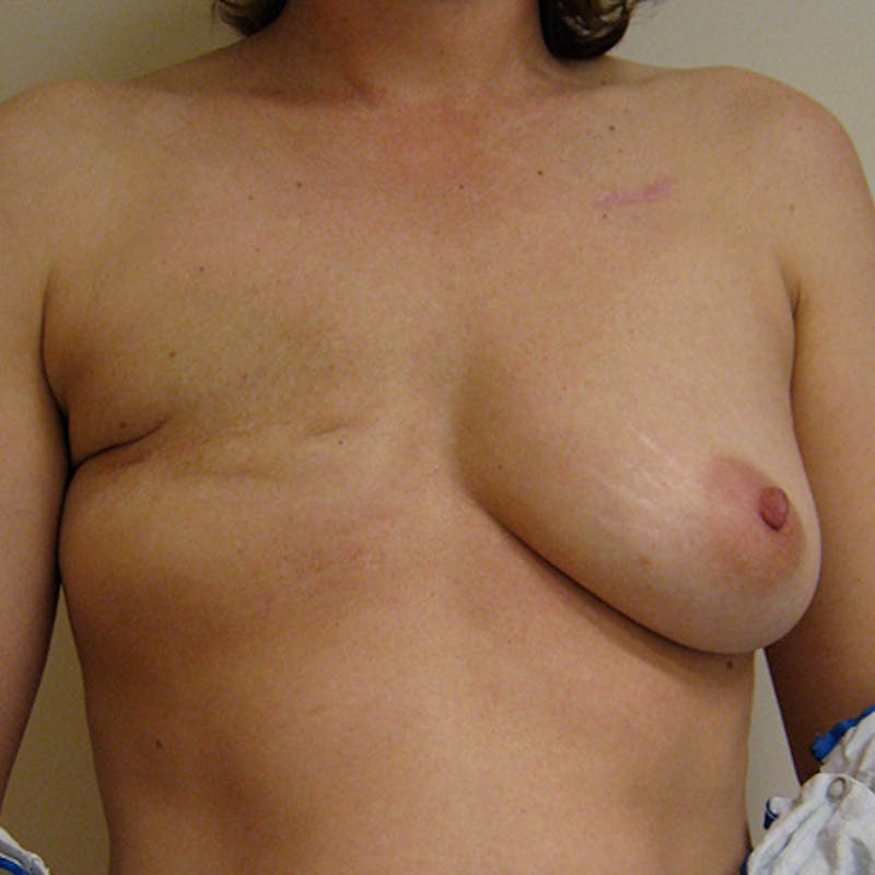 Latissimus Flap Reconstruction Before & After Gallery - Patient 154948958 - Image 1