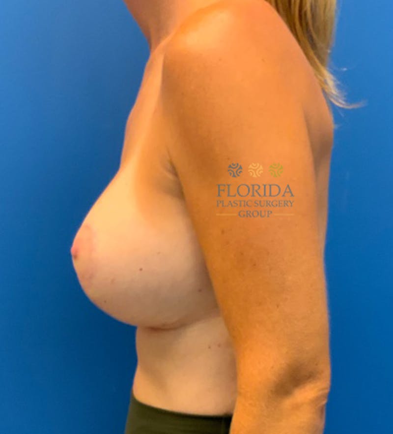 Augmentation Mastopexy Before & After Gallery - Patient 154948957 - Image 4