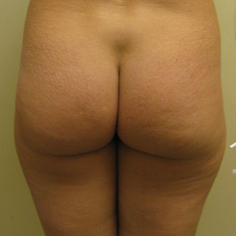 Brazilian Butt Lift Before & After Gallery - Patient 154948963 - Image 1