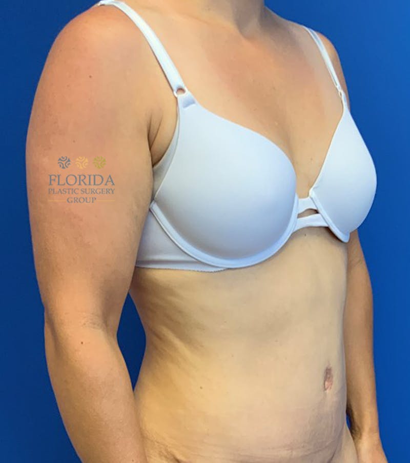 Abdominoplasty Before & After Gallery - Patient 154948954 - Image 4