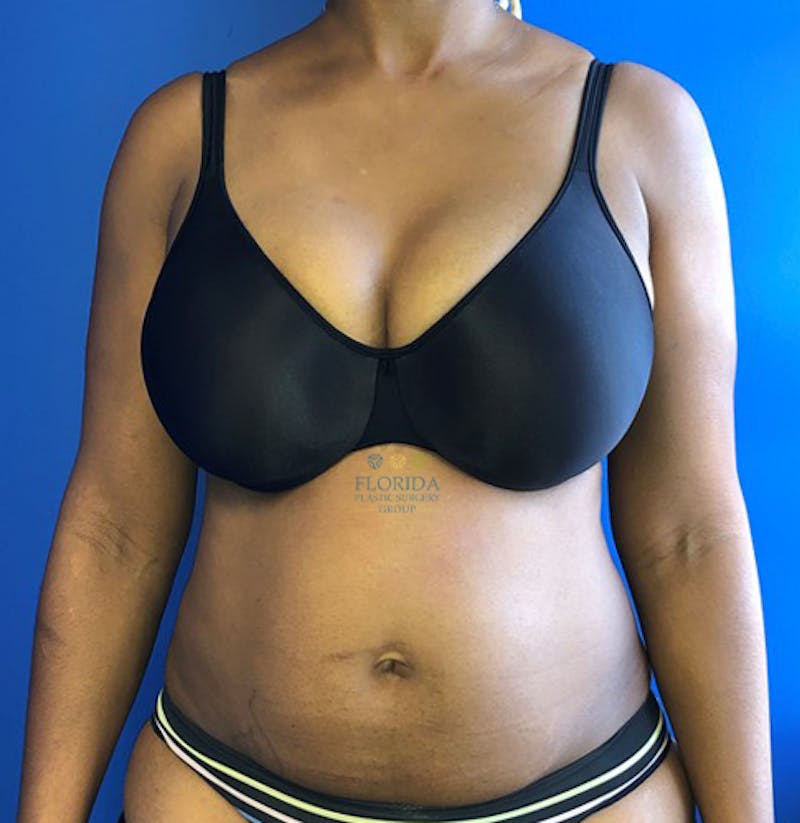 Abdominoplasty Before & After Gallery - Patient 154948970 - Image 1