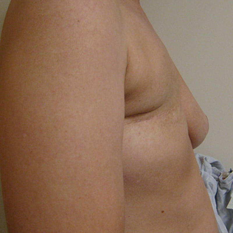 Latissimus Flap Reconstruction Before & After Gallery - Patient 154948958 - Image 3