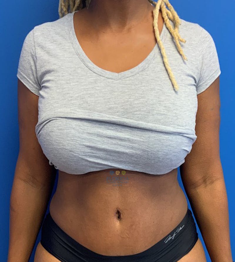 Abdominoplasty Before & After Gallery - Patient 154948970 - Image 2