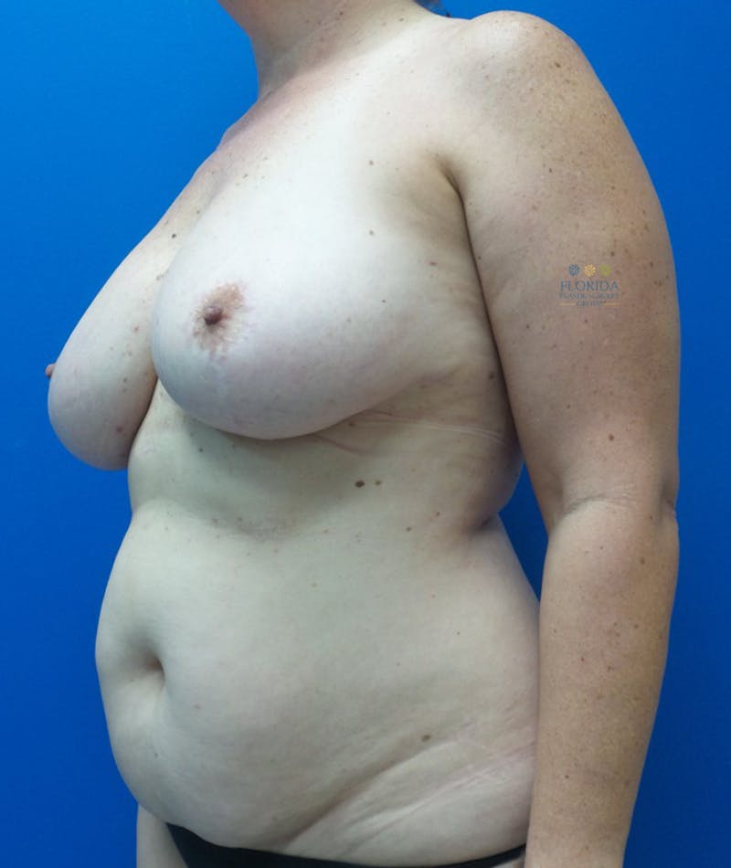 DIEP Flap Reconstruction Before & After Gallery - Patient 154948961 - Image 5