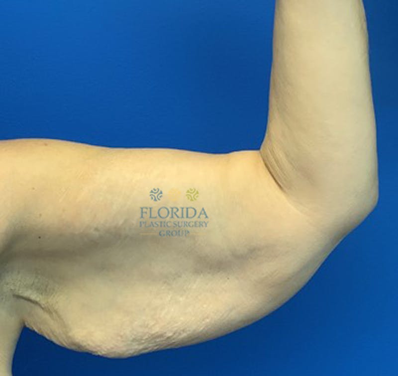 Arm Lift Before & After Gallery - Patient 154948965 - Image 3