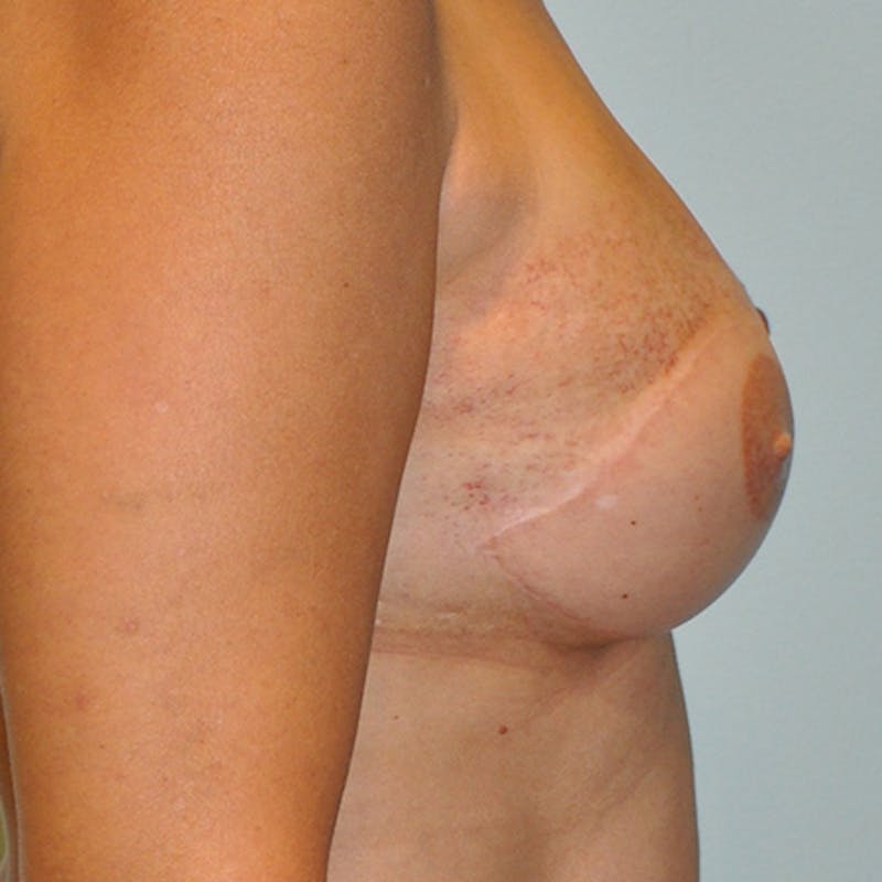 Latissimus Flap Reconstruction Before & After Gallery - Patient 154948958 - Image 4
