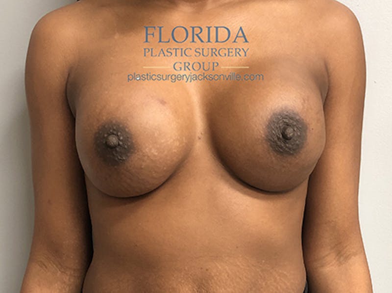 Nipple Sparing Breast Reconstruction Before & After Gallery - Patient 154948971 - Image 2