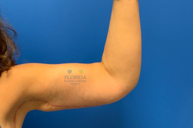 Arm Lift Before & After Gallery - Patient 154948965 - Image 4