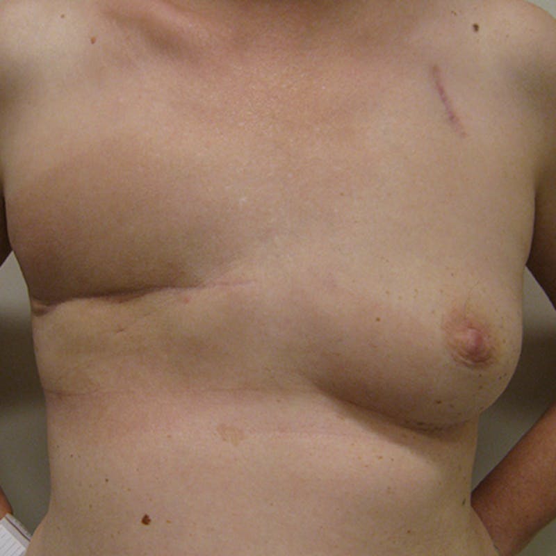 Latissimus Flap Reconstruction Before & After Gallery - Patient 154948974 - Image 1