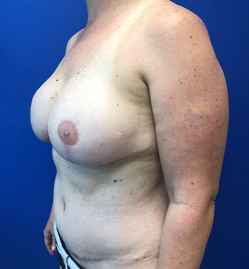 DIEP Flap Reconstruction Before & After Gallery - Patient 154948961 - Image 6