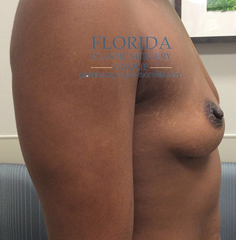 Nipple Sparing Breast Reconstruction Before & After Gallery - Patient 154948971 - Image 3