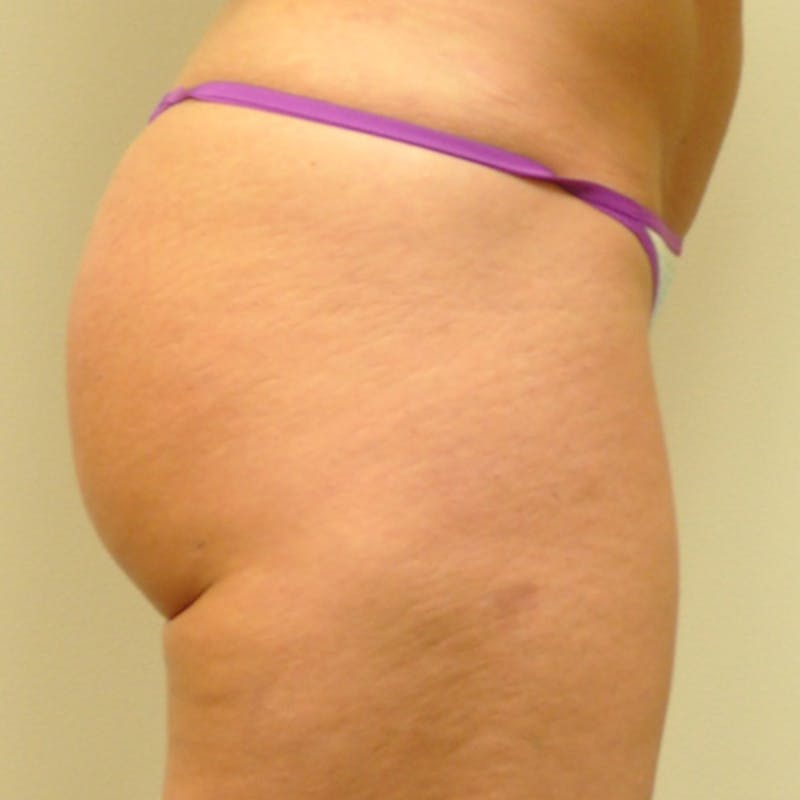 Brazilian Butt Lift Before & After Gallery - Patient 154948963 - Image 6