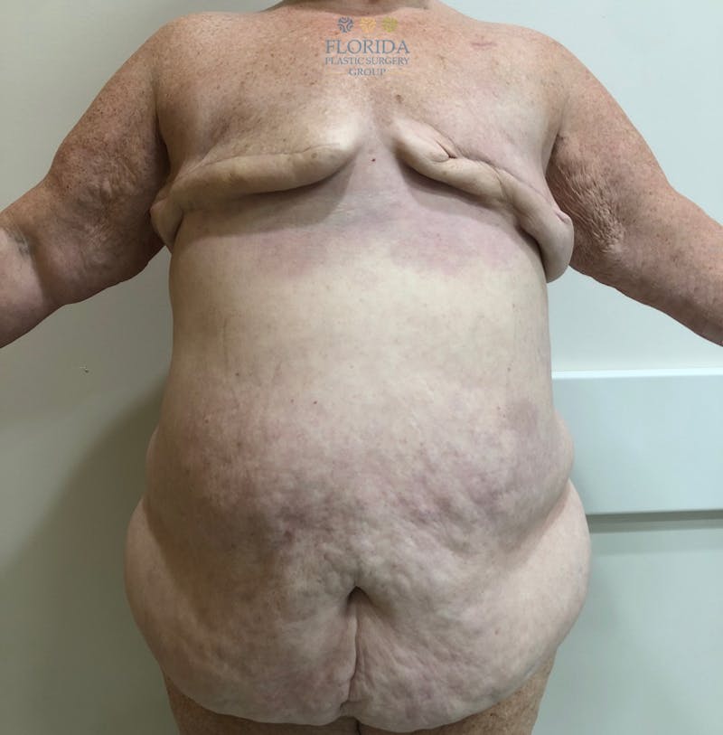 DIEP Flap Reconstruction Before & After Gallery - Patient 154948968 - Image 1