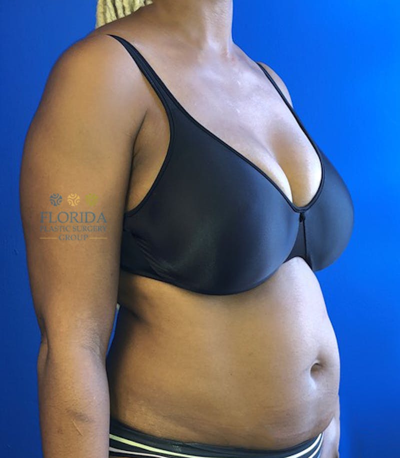 Abdominoplasty Before & After Gallery - Patient 154948970 - Image 5