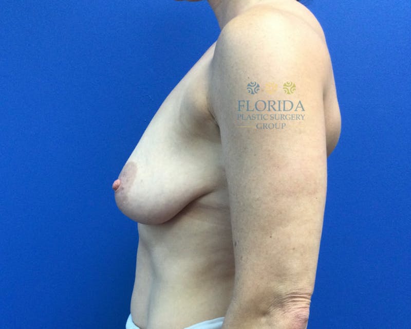 Augmentation Mastopexy Before & After Gallery - Patient 154948976 - Image 3