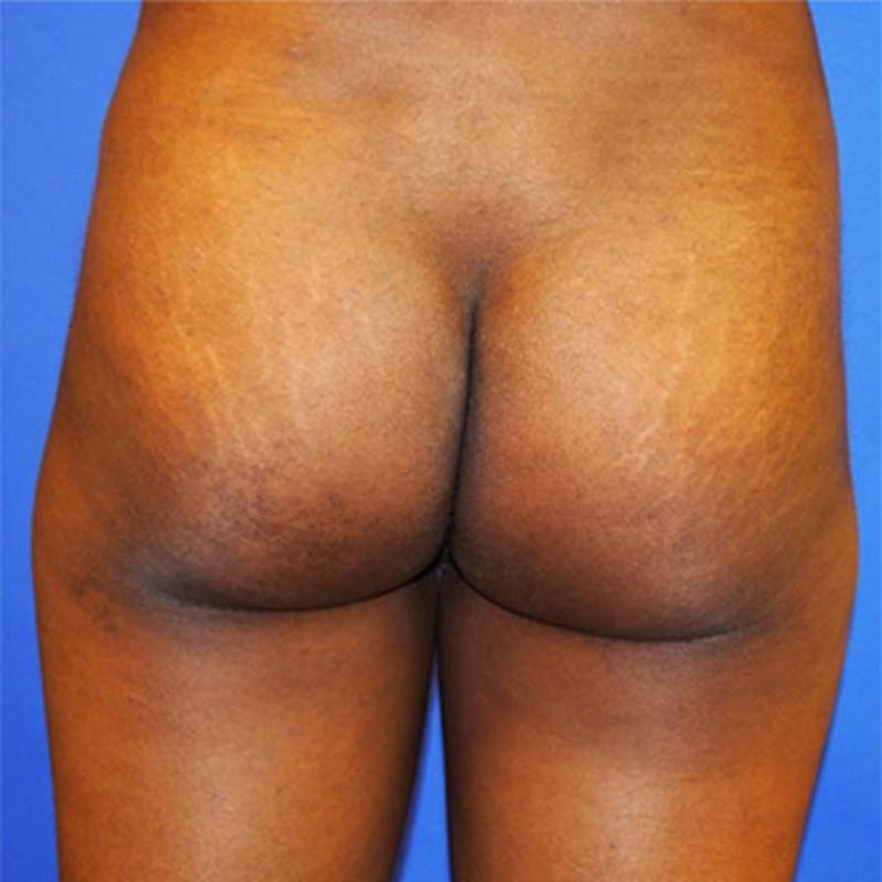Brazilian Butt Lift Before & After Gallery - Patient 154948975 - Image 1