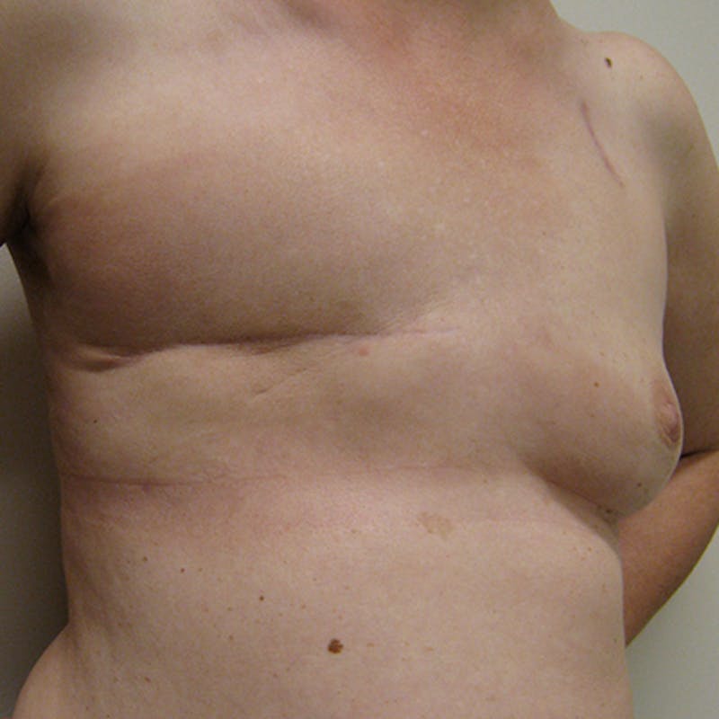 Latissimus Flap Reconstruction Before & After Gallery - Patient 154948974 - Image 3
