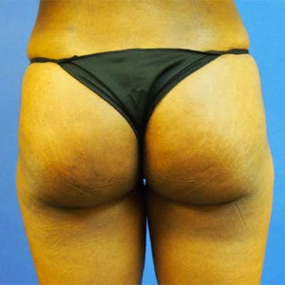 Brazilian Butt Lift Before & After Gallery - Patient 154948975 - Image 2